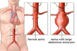 Biến chứng của phình động mạch chủ bụng