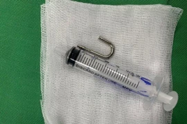 Bé 20 tháng tuổi nuốt móc ổ khóa vào bụng