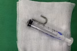 Bé 20 tháng tuổi nuốt móc ổ khóa vào bụng