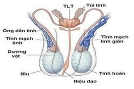 Xử lý giãn tĩnh mạch tinh