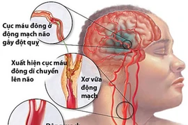Thảo dược phòng chữa xuất huyết não