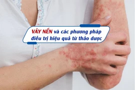 Vảy nến và các phương pháp điều trị hiệu quả từ thảo dược