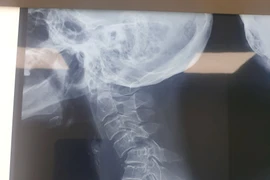 Cứu bệnh nhân gãy trật cột sống cổ 