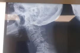 Cứu bệnh nhân gãy trật cột sống cổ 