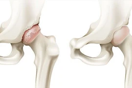Cố chịu đau dẫn tới phải thay khớp háng