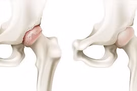 Cố chịu đau dẫn tới phải thay khớp háng