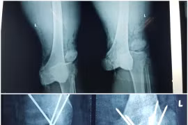  Trắng đêm để cứu chân dập nát của tài xế