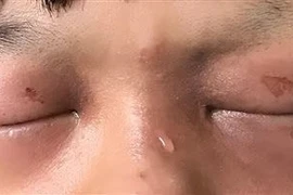  Cẩn thận chấn thương mắt do hỏa khí