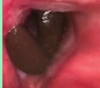 Ho ra máu vì đỉa chui khí quản