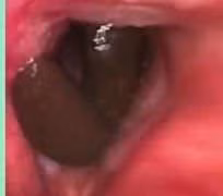 Ho ra máu vì đỉa chui khí quản