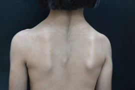 Phát hiện bệnh di truyền hiếm gặp: Hội chứng Cantú