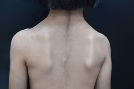 Phát hiện bệnh di truyền hiếm gặp: Hội chứng Cantú