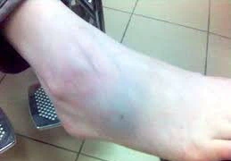 Tại sao bong gân phải bó bột?