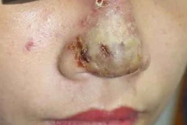 Ổ mủ mũi sau khi tiêm Filler