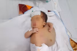 Mổ thành công cho bé 10 ngày tuổi u khổng lồ chiếm nửa cơ thể.