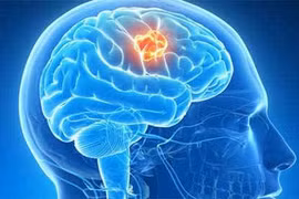 U não nguy hiểm có thể xảy ra ở mọi lứa tuổi