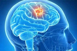 U não nguy hiểm có thể xảy ra ở mọi lứa tuổi