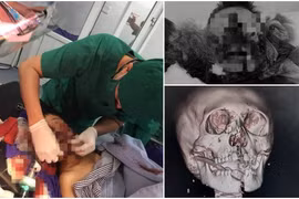 Hội chẩn từ xa cứu trẻ 9 tuổi dập nát vùng mặt do pháo tự chế