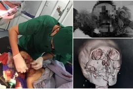 Hội chẩn từ xa cứu trẻ 9 tuổi dập nát vùng mặt do pháo tự chế