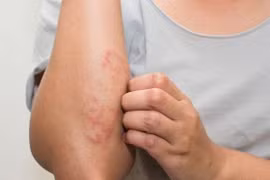 Viêm da cơ địa, điều trị thuốc Tây hay thuốc Nam?