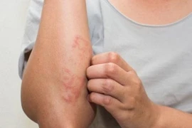 Viêm da cơ địa, điều trị thuốc Tây hay thuốc Nam?