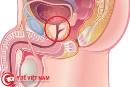 Biến chứng thường gặp của u xơ tiền liệt tuyến