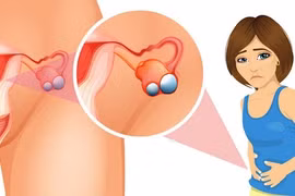 U nang buồng trứng thường gặp ở độ tuổi nào? Làm sao để phòng bệnh?