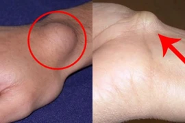 U sụn mọc nhiều ở tay, chân