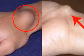 U sụn mọc nhiều ở tay, chân