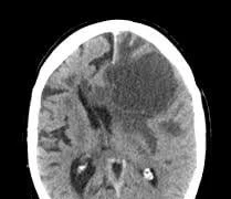 Điều trị ung thư phổi di căn não