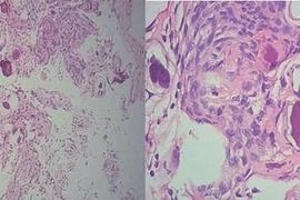 Suýt liệt vì u màng tủy