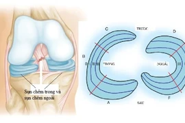 Rách sừng sau sụn chêm