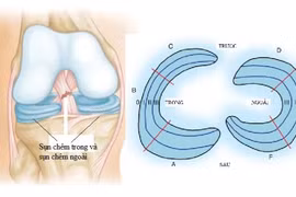 Rách sừng sau sụn chêm