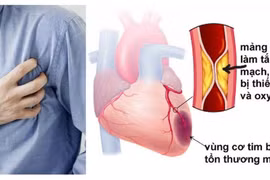 Đừng coi thường chứng đau thắt ngực ổn định