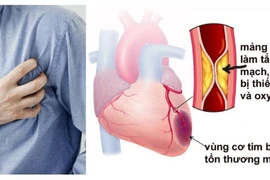 Đừng coi thường chứng đau thắt ngực ổn định