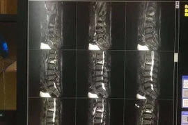 Không chủ quan với đau lưng