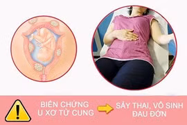 Cẩn trọng với những biến chứng nguy hiểm của bệnh u xơ tử cung