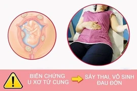 Cẩn trọng với những biến chứng nguy hiểm của bệnh u xơ tử cung