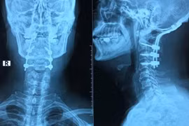 Gãy đốt sống cổ do nhảy ở bể bơi