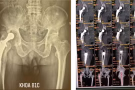 Lưu ý khi lựa chọn loại khớp để tránh thay lại khớp háng 