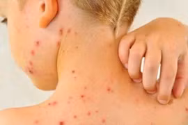 Người bị thủy đậu có được ăn sữa chua không?