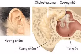 Viêm xương chũm cấp tính do viêm tai giữa