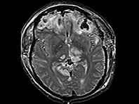 Hiểu được hậu quả của chấn thương đầu đối với các bệnh thần kinh