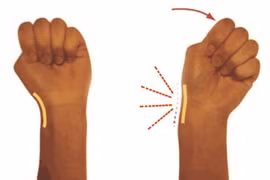 Đau vùng cổ tay trên ngón cái