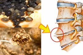 Phản khoa học khi dùng hạt đu đủ chữa gai cột sống