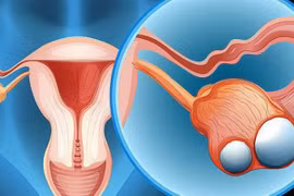 Giải pháp cải thiện u nang buồng trứng ở người già hiệu quả từ thảo dược