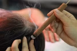 Dùng cứu ngải chữa bệnh