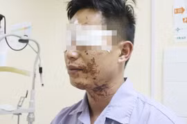 Nổ bình ga khi ăn lẩu người đàn ông bỏng vùng mặt