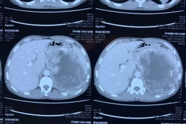 Kỹ thuật cao cứu sống người bệnh có khối u thượng thận khổng lồ