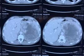 Kỹ thuật cao cứu sống người bệnh có khối u thượng thận khổng lồ